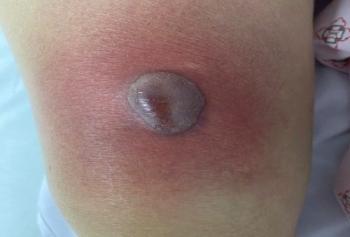 Những vết đỏ trên da đe dọa tính mạng