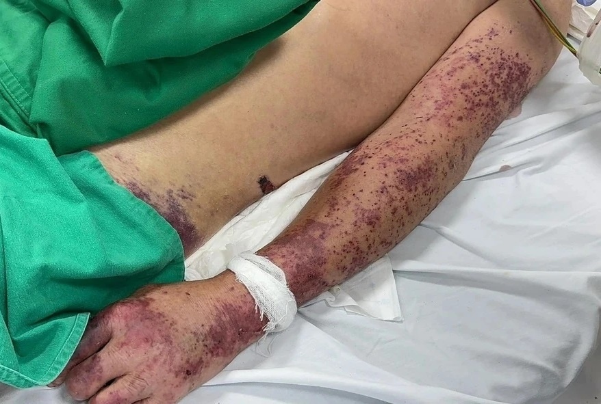 Ăn lòng lợn, nem chua, thanh niên 33 tuổi nhiễm bệnh nguy hiểm