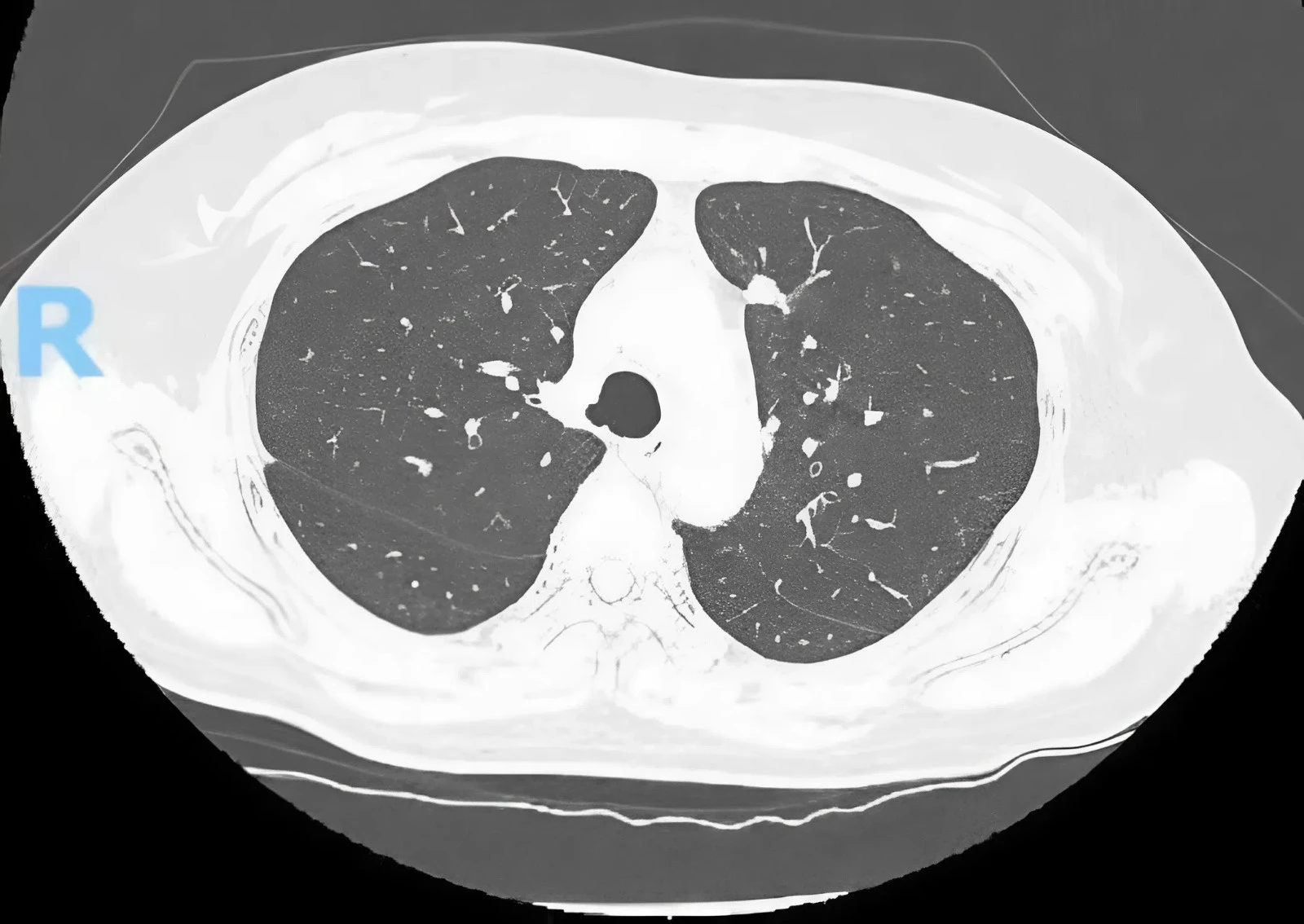 Bất ngờ phát hiện mắc ung thư từ nốt mờ nhỏ ở phổi