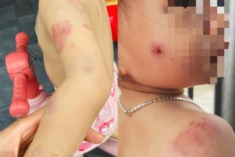 Bé gái hơn 2 tuổi chi chít vết cắn trên người sau giờ học