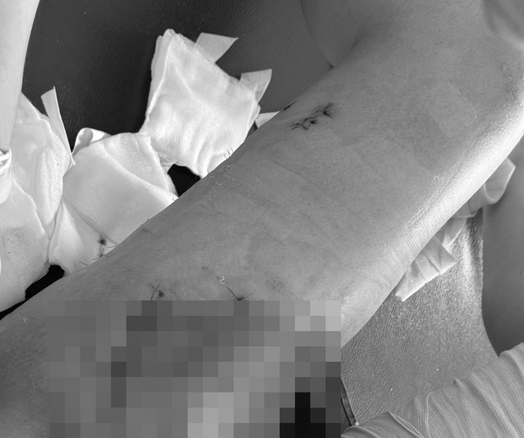 Cứu cô gái 25 tuổi bị xe tải 10 tấn kéo lê